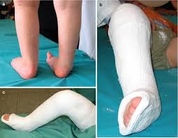 In am, usually use clubfoot. Management Of Clubfoot Springerlink