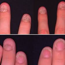 A Nail Lichen Planus In An 11 Year Old Male Patient Before Treatment Download Scientific Diagram The ideal gift for 10 year old girls everywhere, it comes with a 56 page book full to the brim with instructions. a nail lichen planus in an 11 year old