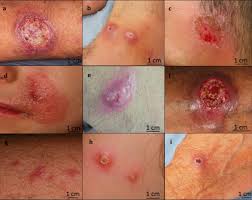 Clinical appearance of Mediterranean cutaneous leishmaniasis lesions... |  Download Scientific Diagram