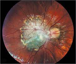 Combined Hamartoma Of The Retina And Retinal Pigment Epithelium Eye Health Retinal Photography Medical Photography