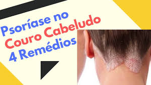 Compartilhe a psoríase no couro cabeludo é uma dermatose inflamatória crônica e recorrente.é caracterizada pela presença de placas eritematosas delimitadas com descamação branca. Psoriase No Couro Cabeludo Tratamento 4 Remedios Youtube