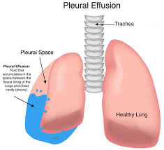 Image result for Pneumonia