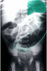 Hirschsprung Disease Amboss