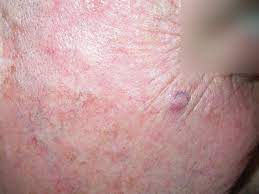 Concept meaning a condition or an individual producing or showing no symptoms elements of this image furnished by nasa. Acd A Z Of Skin Merkel Cell Carcinoma