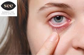 Image result for Dry Eye