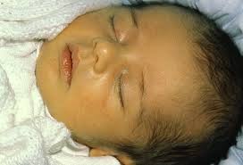 Bayi kuning atau yang dikenal dengan ikterus neonatorum, dialami oleh bayi yang baru lahir. Kekuningan Pada Bayi Normal Atau Bahaya Dr Zubaidi Hj Ahmad Menulis