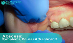 Image result for Periodontal Abscess