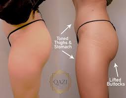 How long does sculptra take to work? Does Sculptra For Cellulite Really Work Qazi Cosmetic Clinic