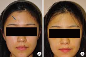 Preoperative and postoperative photographic findings A preoperative...