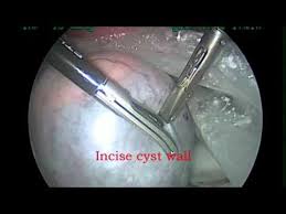 Pin By Lacie B On Ovarian Cysts Ovarian Cyst Ovarian Cysts