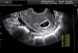 Diagnostic Ultrasound In The First Trimester Of Pregnancy