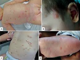 Image result for Urticaria pigmentosa children