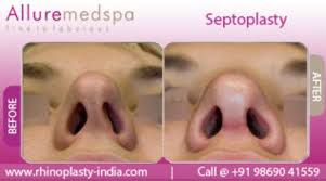 Septoplasty Is Also Known As Deviated Septum Rhinoplasty That Designed To Correct The Shape Of The Septu Rhinoplasty Cost Rhinoplasty Nose Job Cost Rhinoplasty