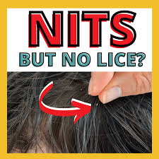 Image result for lice vs nits