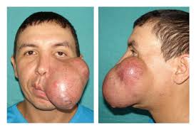 Image result for Dermatofibrosarcoma Protuberans