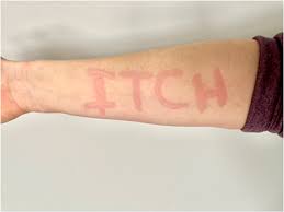 Image result for Dermatographism