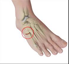 A jones fracture happens when one of the bones on the top of the foot breaks. Jones Fracture Bunbury Foot Ankle Surgeon