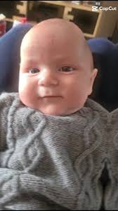 Craniosténose Morgane