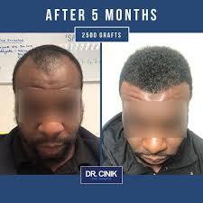 Men and women, young and old, black or white — all are susceptible to hair loss. Is The Fue Technique Efficient To Transplant Afro Frizzy Hair