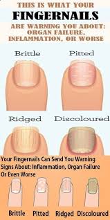 This Is What Your Fingernails Are Warning You About Organ Failure Inflammation Or Worse With Images Fingernails Healthy Natural Living Inflammation