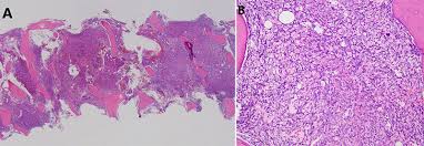 Image result for Bone Marrow Exam