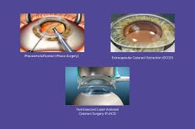 Image result for Cataract Extraction