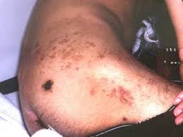 Image result for skin rash acute hiv infection
