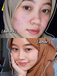 bebas dari jerawat membandel ? tentu bisa