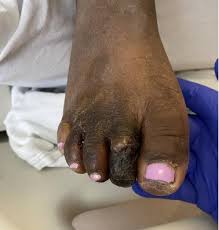 Image result for toe black diabetes