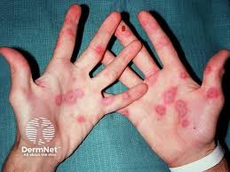 Image result for Erythema Multiforme Major