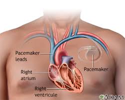 The pacemaker is an electronic biomedical device that can regulate the human heartbeat when its first developed in the 1950s, the pacemaker has undergone various design changes and has found. Pacemaker Medlineplus Medical Encyclopedia Image