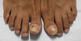 Image result for Beau lines feet