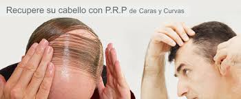 Recuperar El Cabello Perdido Con P R P En Factores De Crecimiento Mi Sitio