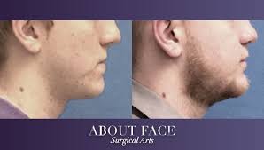 A double jaw surgery costs about $35,000 in a private hospital, depending on the actual surgery done, amount of time taken, the ward class, etc. Jaw Orthognathic Surgery About Face Surgical Arts