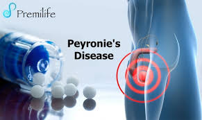 Keeping your blood sugars within the normal range will help prevent your neuropathy from worsening. Peyronie S Disease Premilife Homeopathic Remedies