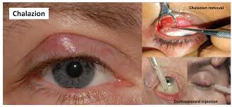 Swollen Eyelid Know The Causes Remedies And Alert Signs
