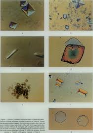 Image result for Calcium Nephrolithiasis