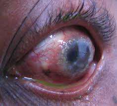 Image result for Vernal Conjunctivitis