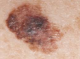 We may earn commission from links on this page, but we only r. Skin Cancer Colleyville Dermatology