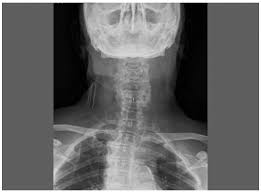 SciELO Brasil - Dysphagia due to anterior cervical osteophytosis: case  report Dysphagia due to anterior cervical osteophytosis: case report
