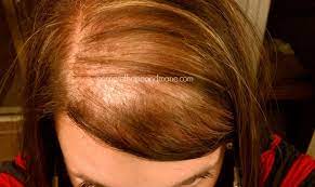 But emily admitted that she turned to hair extensions to cover up her hair loss, rather than looking for remedies to help her hair grow back stronger. Products To Hide Women S Hair Loss