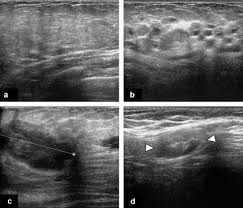 What are the symptoms, and how is it diagnosed and treated? Inflammatory Breast Disease The Radiologist S Role Sciencedirect