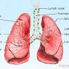 If you are a former smoker, your risk is decreased, but has not gone away completely—you can still get lung cancer. 1