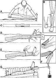 Surgery At The District Hospital Obstetrics Gynaecology Orthopaedics And Traumatology Orthopaedics And Traumatology Basic Techniques 10 Traction Lower Limb Traction