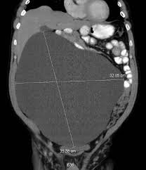 Check spelling or type a new query. Mesothelioma As A Rapidly Developing Giant Abdominal Cyst Springerlink