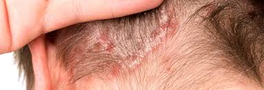 Image result for Pustular Psoriasis