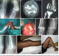 Figure 3 from Complex AO type C3 distal femur fractures ...