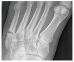 A jones fracture is a fracture at the base of 5th metatarsal (the long bone on the outside of the foot). Fifth Metatarsal Fractures And Current Treatment