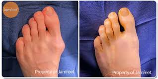 The information below will help many bunion surgery patients eliminate their pain. Before After Bunion Surgery Photo Gallery Los Angeles Foot Doctor Beverly Hills