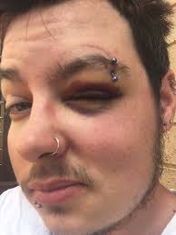 Fainting from low blood sugar and no breakfast